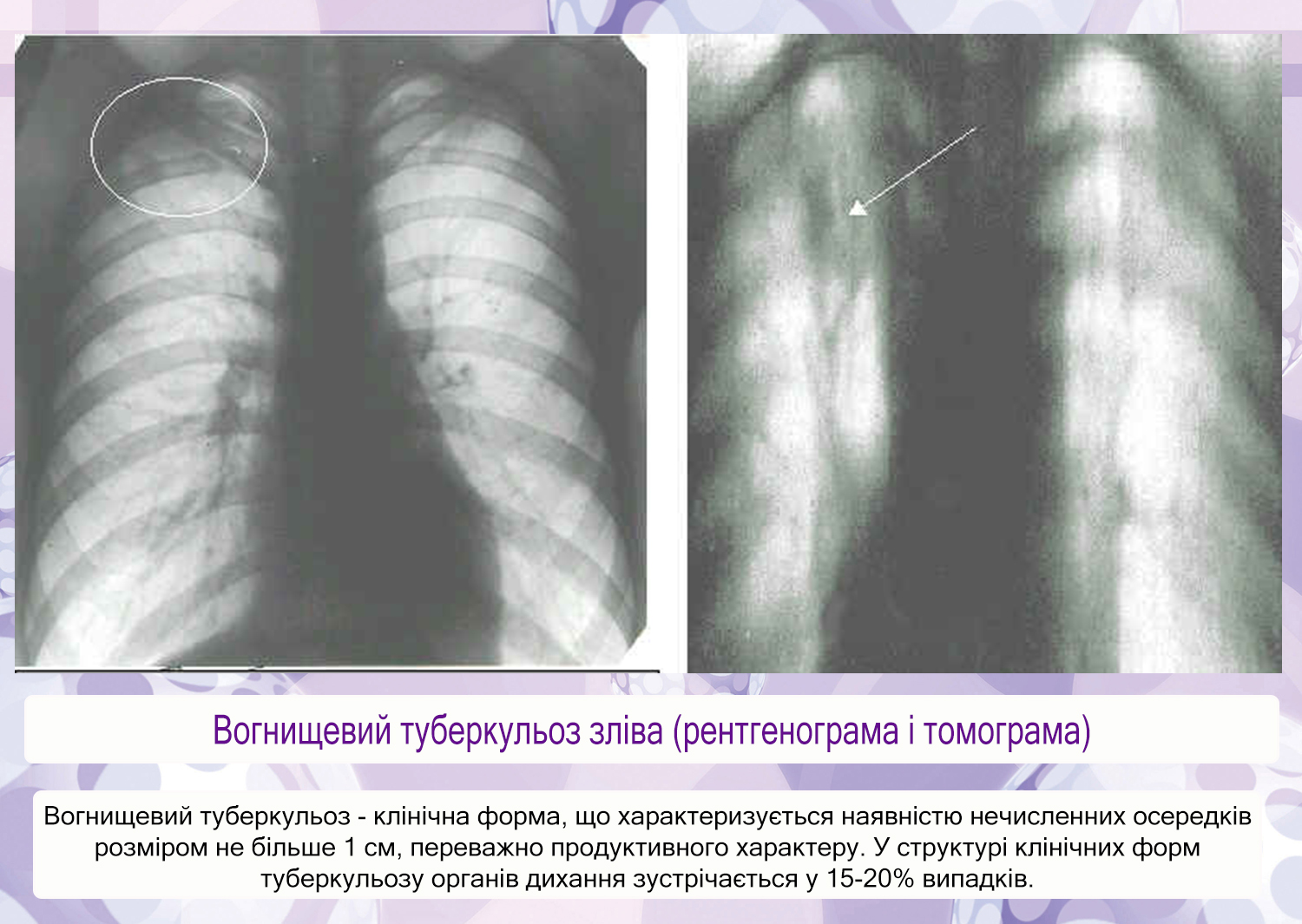 Туберкулез у детей симптомы фото начальная стадия Туберкулез у детей симптомы фото начальная стадия