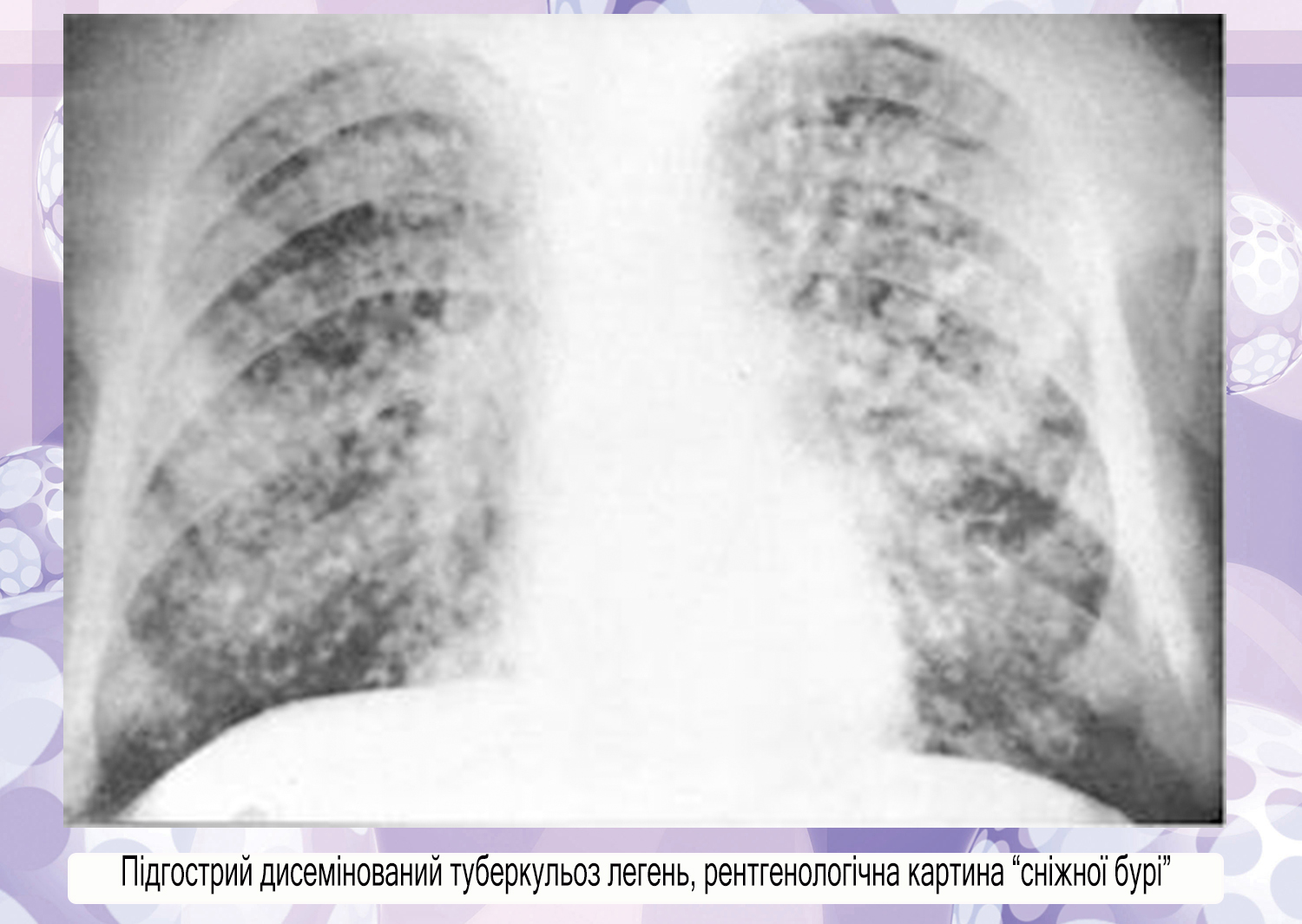 Диссеминированное поражение легких. Острый диссеминированный туберкулез легких рентген. Острый милиарный туберкулез рентген. Подострый диссеминированный туберкулез кт. Хронический диссеминированный туберкулез легких рентген.