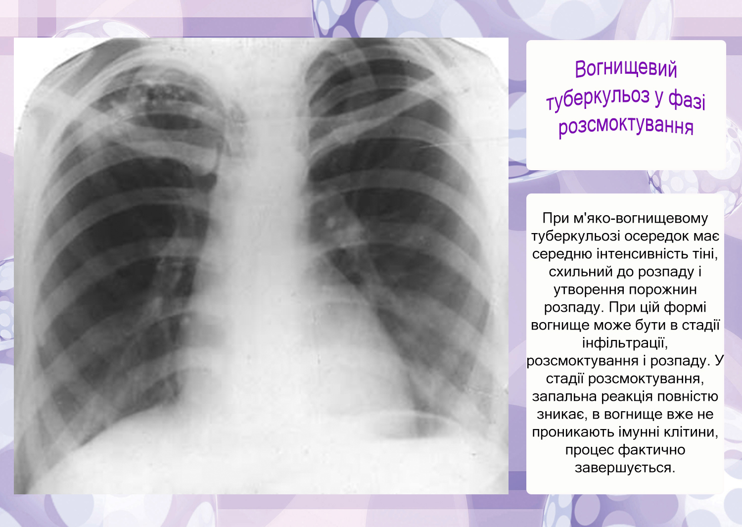 Очаг в верхней доле правого легкого. Инфильтративный туберкулез рентген. Очаговый туберкулез в фазе инфильтрации. Рентгенологическая картина очагового туберкулеза. Казеозная пневмония инфильтрат.